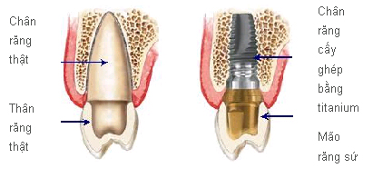 Tìm hiểu rõ hơn về răng Implant
