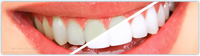 Răng ngã màu và giải pháp tẩy trắng an toàn.