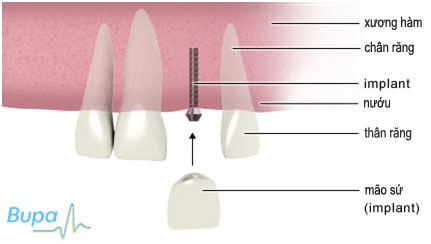 Cấy Ghép Implant Có Răng Giả Sớm